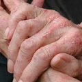 Экзема: причины, виды, фото